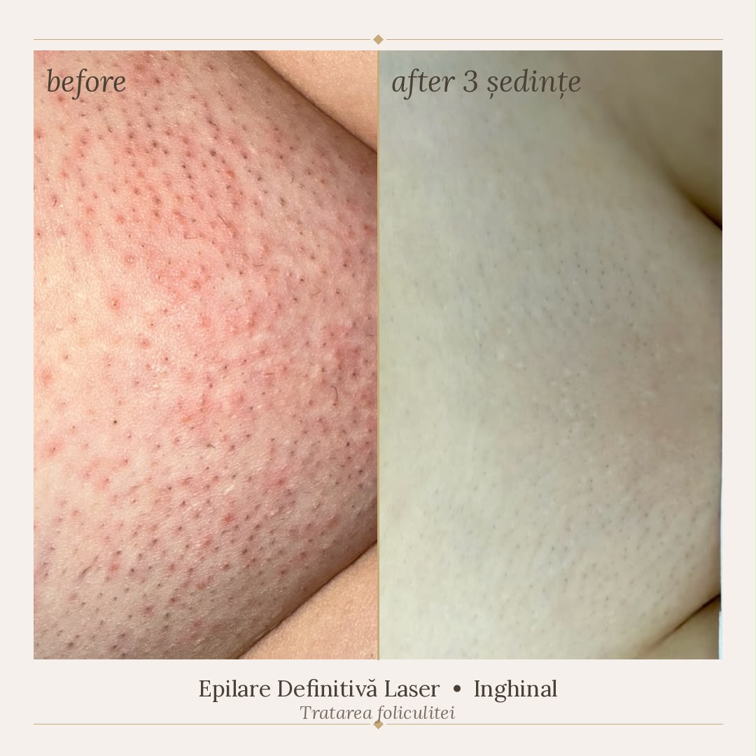 Rezultat epilare definitivă inghinal SkinXpert