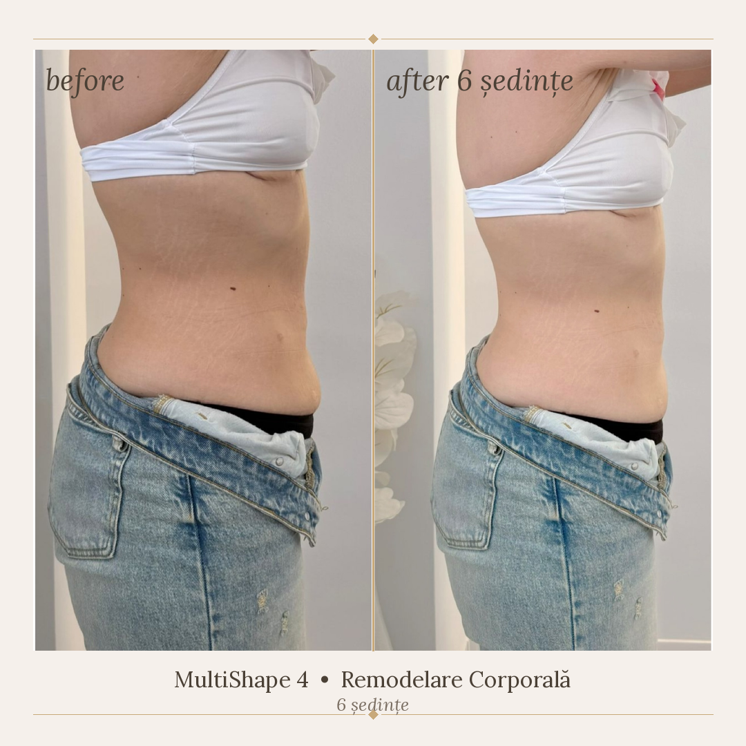 Remodelare corporală abdomen – înainte