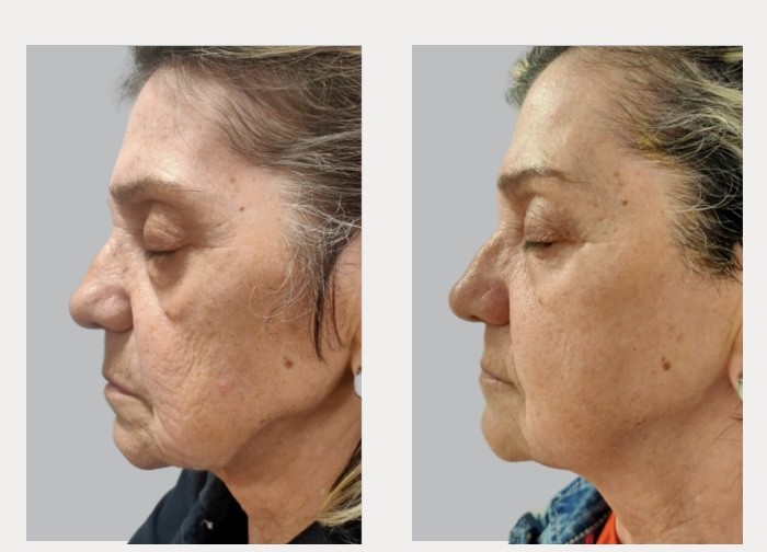 Înainte și după – lifting și fermitate facială cu HERA