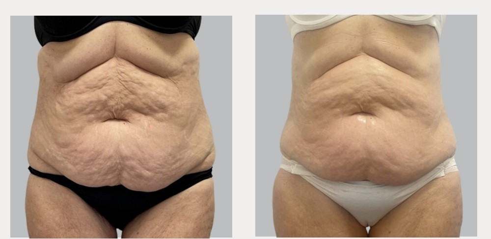 Înainte și după – reducere circumferință abdominală cu HERA