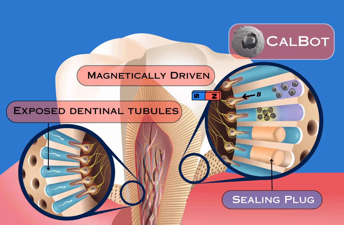 Illustration of Calbots being magnetically maneuvered inside the dentinal tubules and forming a sealing plug in the presence of a magnet