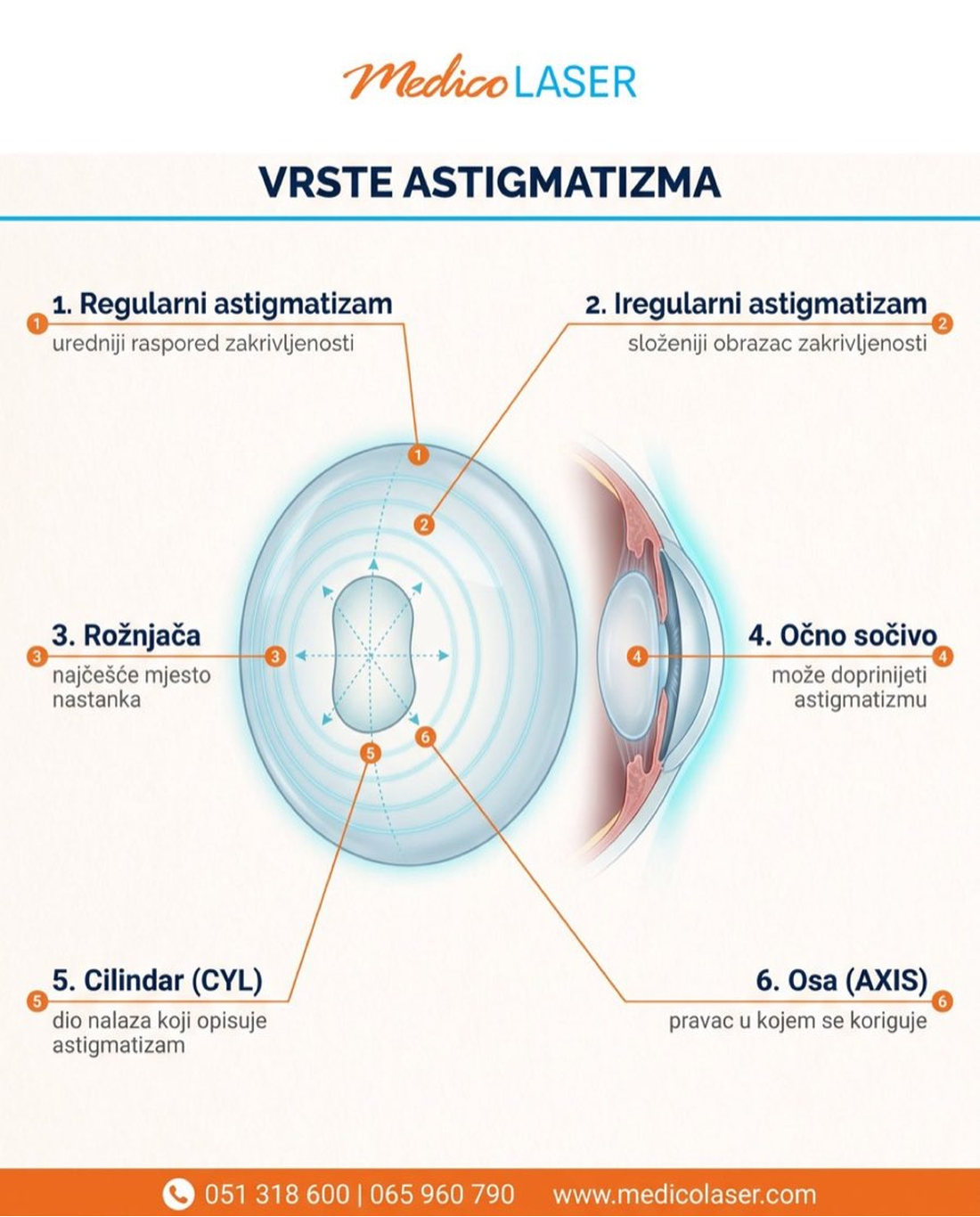 Vrste astigmatizma - infografika