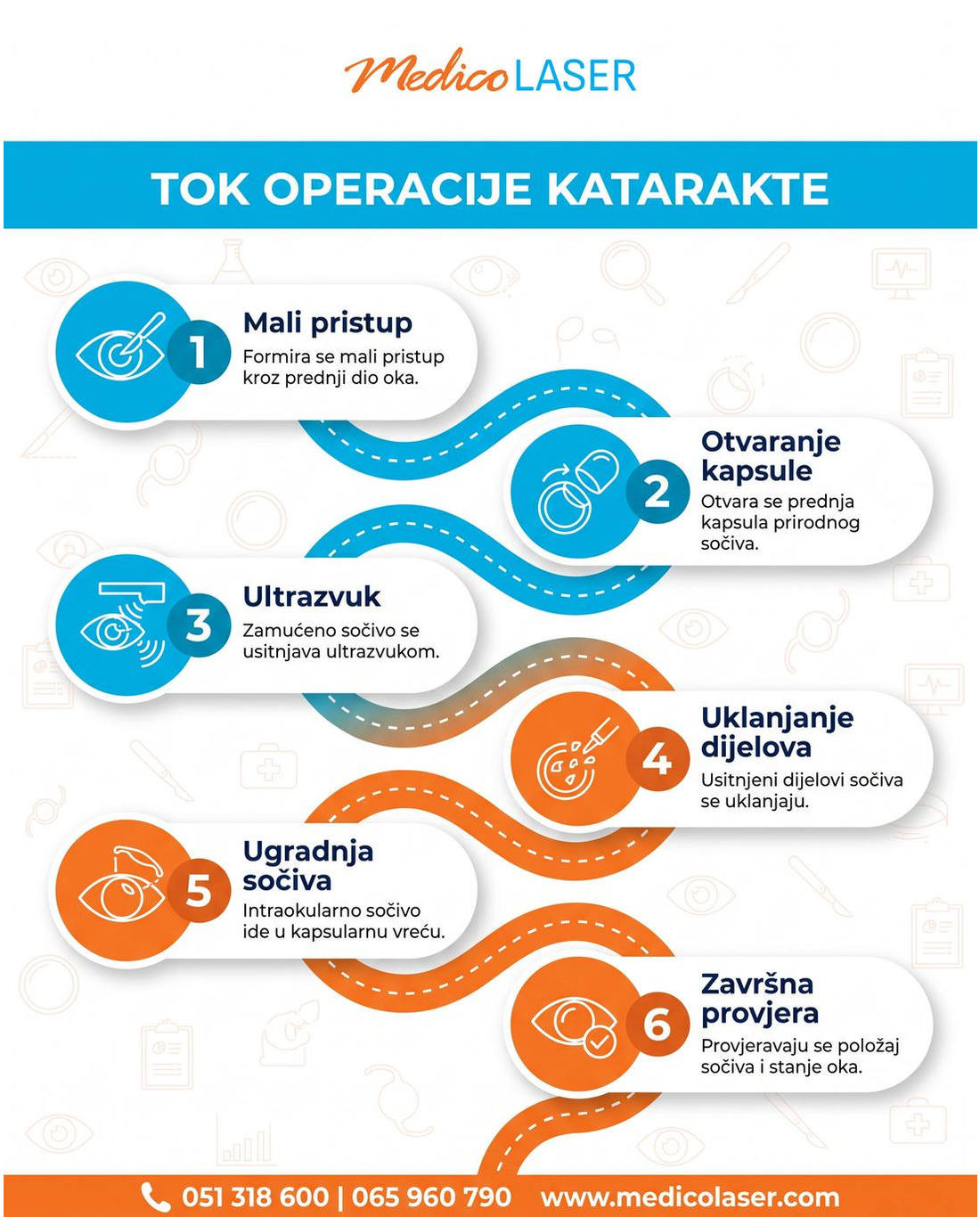 Tok operacije katarakte fakoemulzifikacijom u šest koraka - Medico Laser