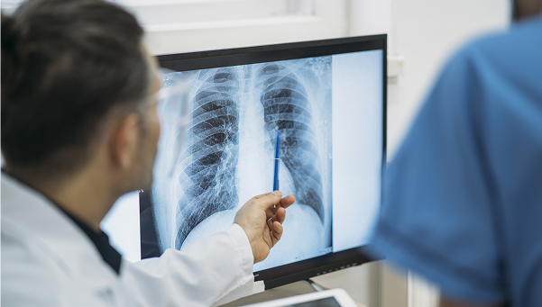 Early lung cancer detection 