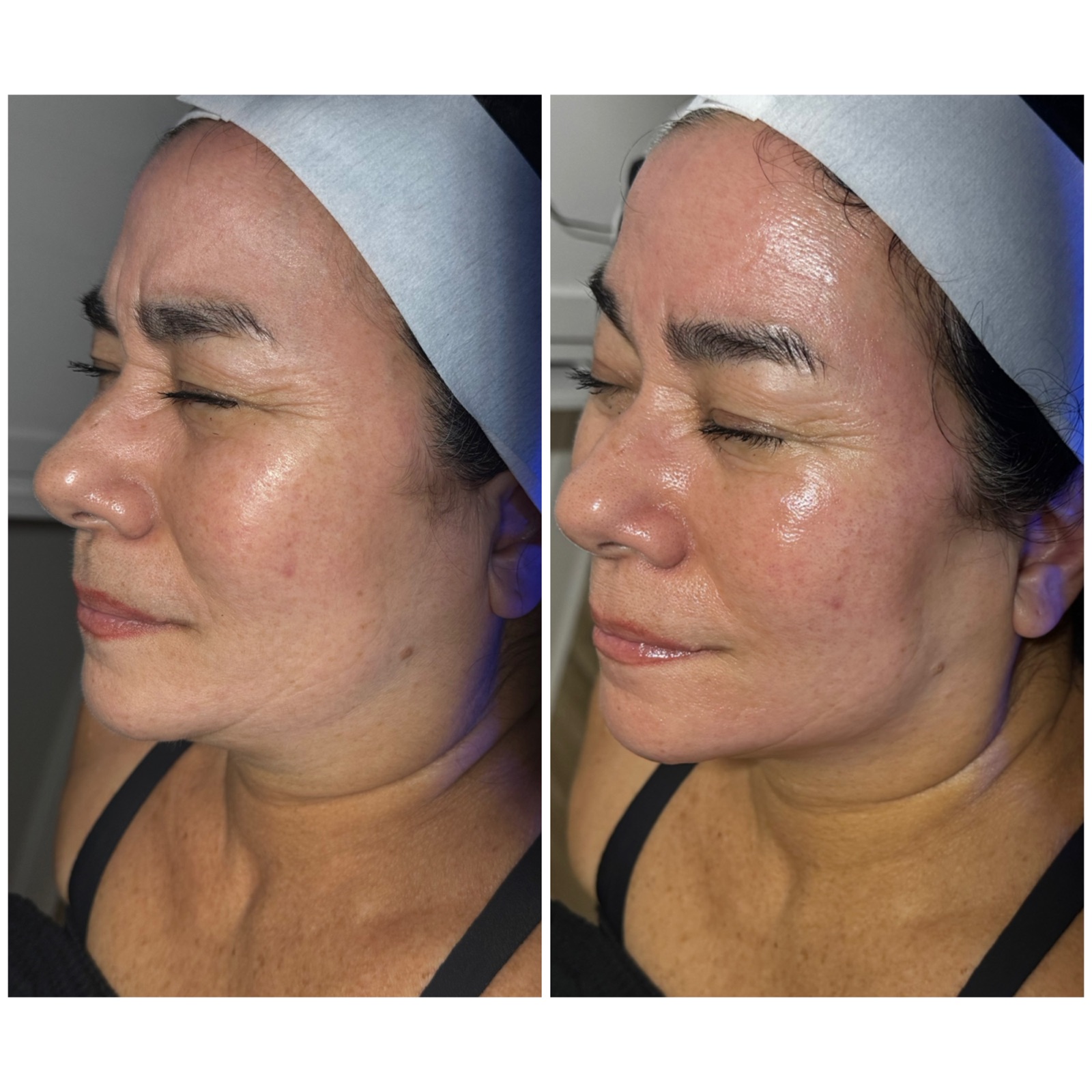HydraFacial before and after results at Nashville Skin Company