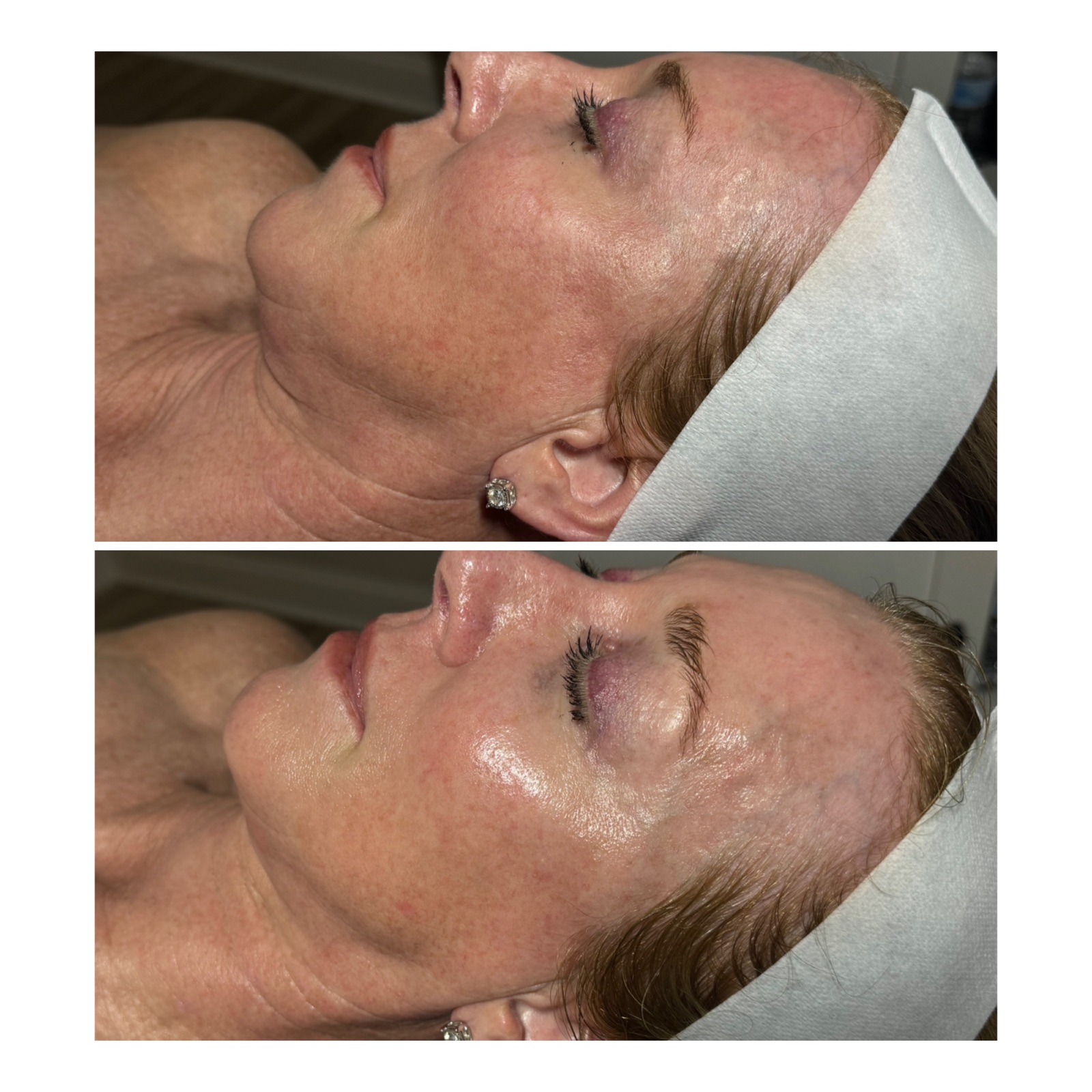 HydraFacial before and after results at Nashville Skin Company