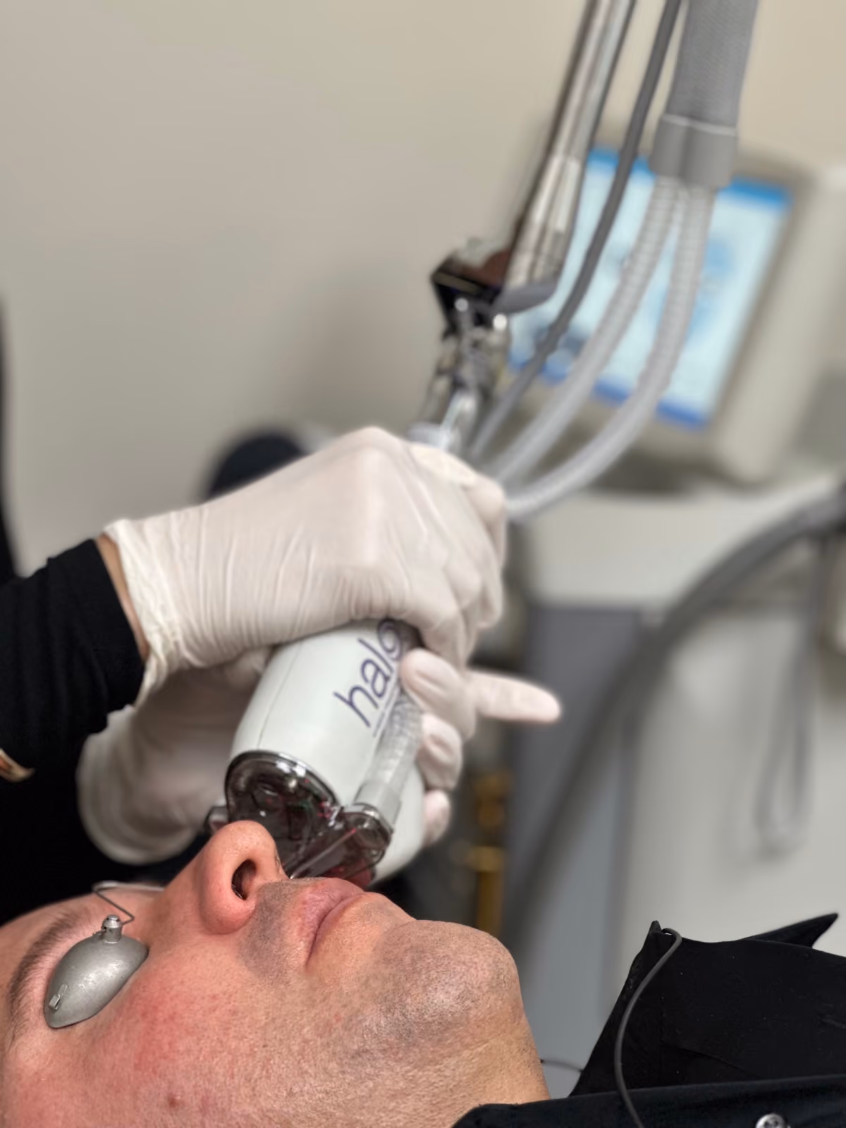 Halo Laser Resurfacing treatment at Nashville Skin Company in Nashville, TN