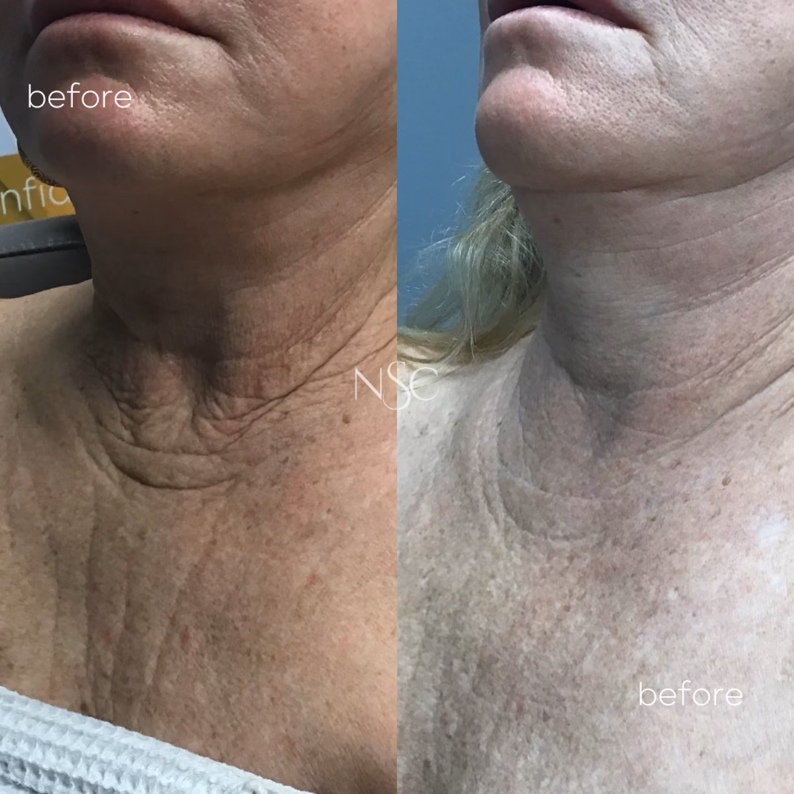Halo Laser Resurfacing at Nashville Skin Company in Nashville, TN
