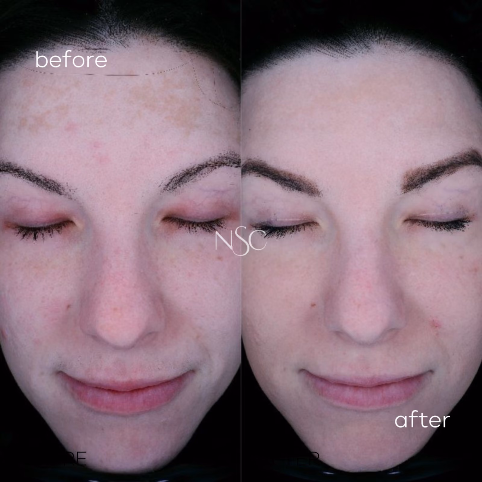 Treatment before and after results at Nashville Skin Company