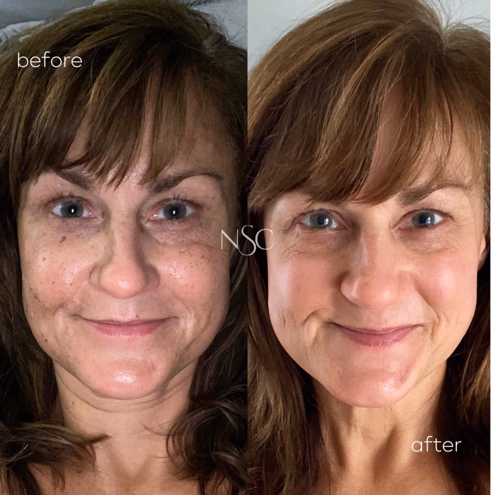BBL Photofacial at Nashville Skin Company in Nashville, TN