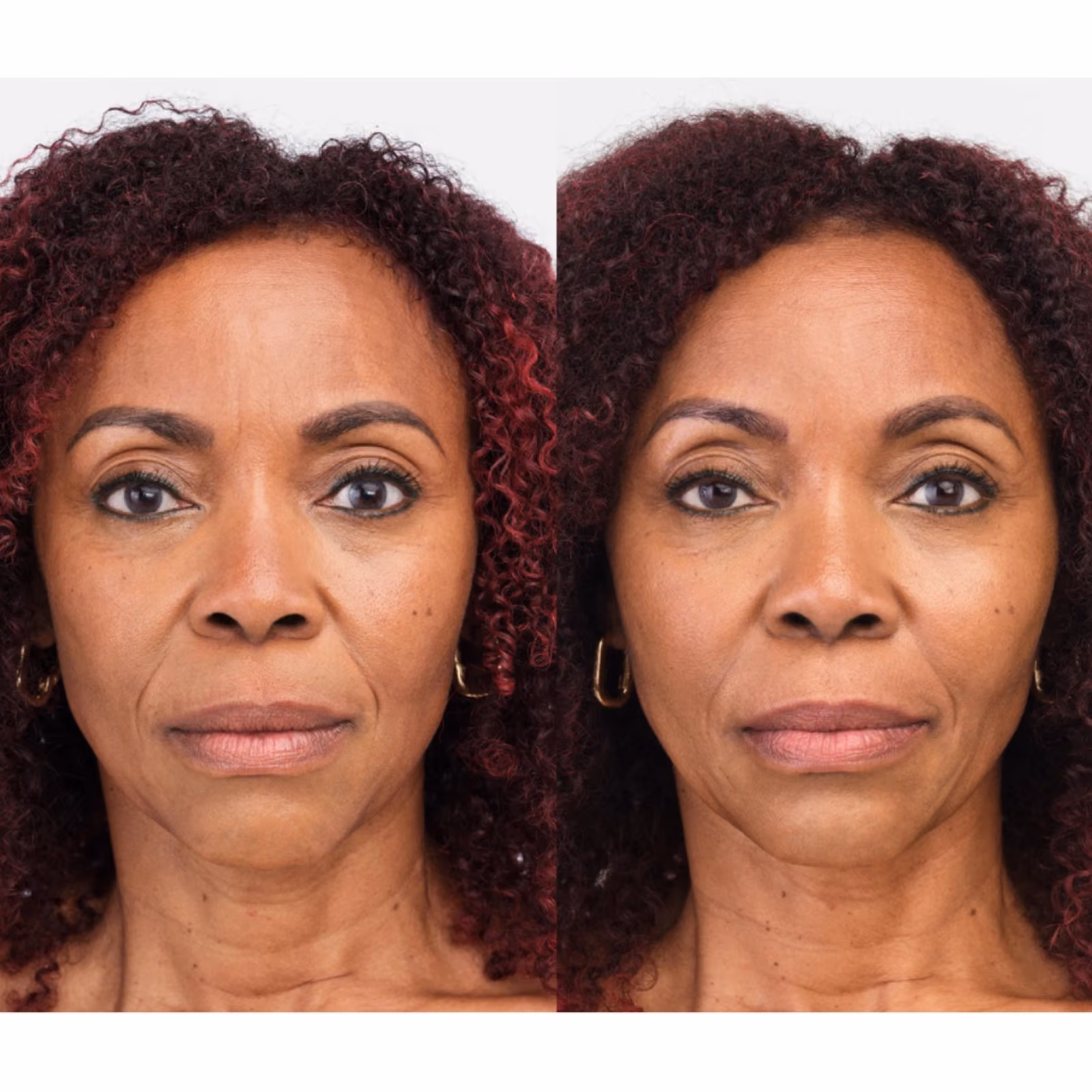 Collagen Biostimulators (Radiesse) at Nashville Skin Company in Nashville, TN