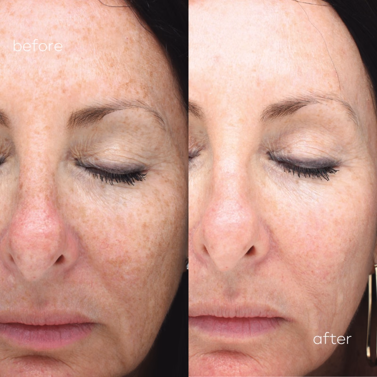 Halo Laser Resurfacing at Nashville Skin Company in Nashville, TN