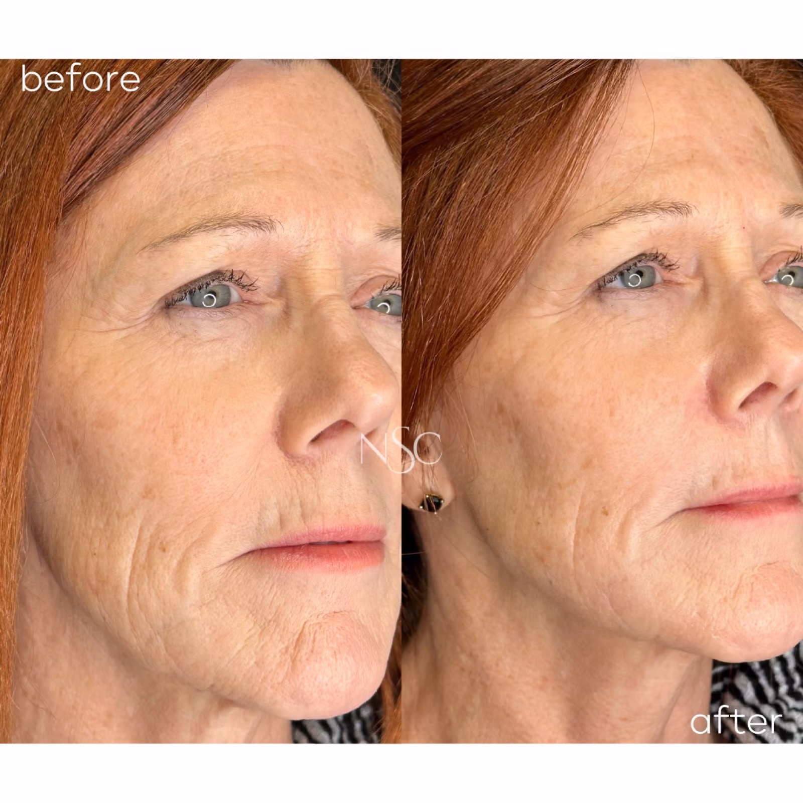 Collagen Biostimulators (Radiesse) at Nashville Skin Company in Nashville, TN