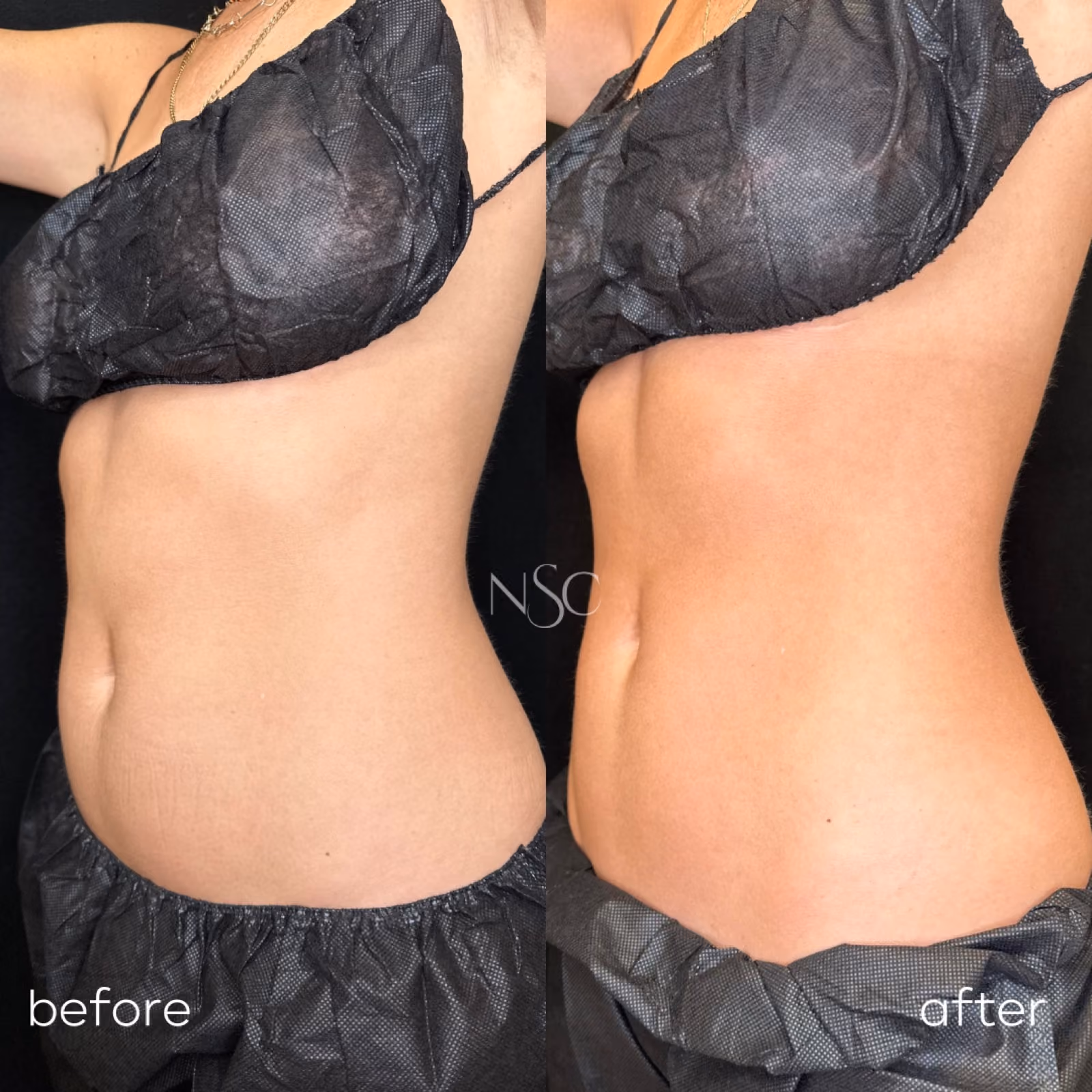 CoolSculpting before and after results at Nashville Skin Company