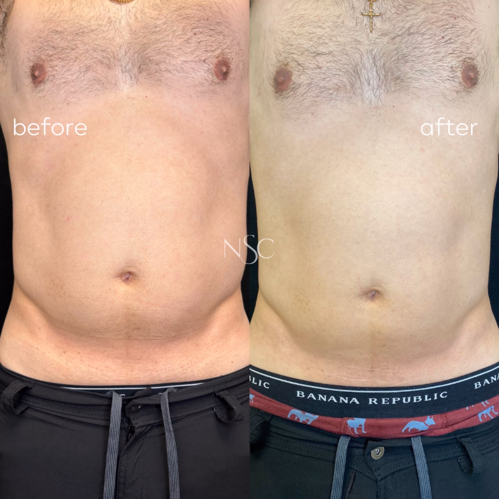 CoolSculpting before and after results at Nashville Skin Company