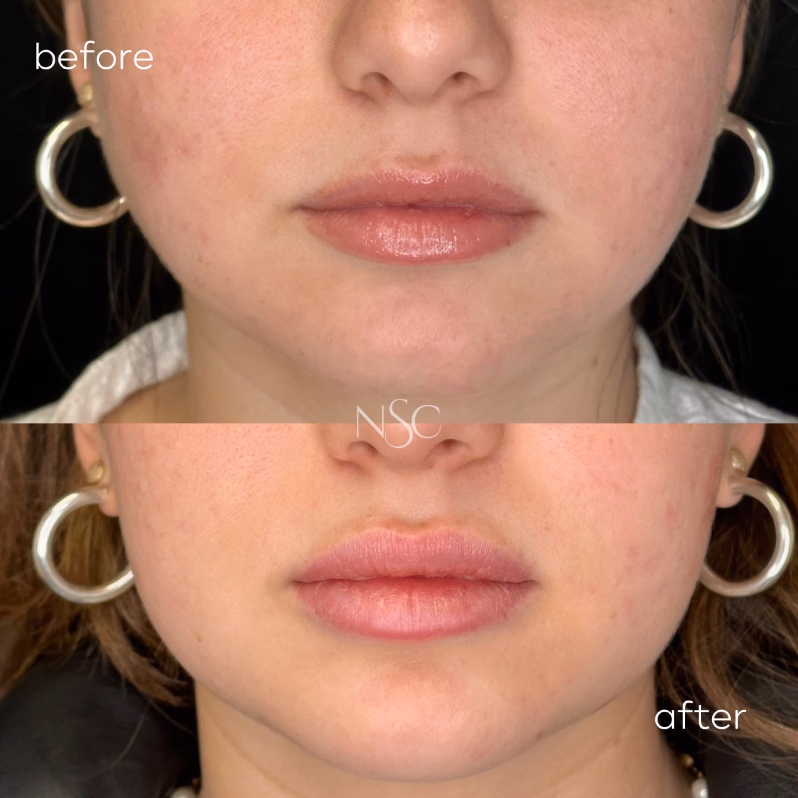 Treatment before and after results at Nashville Skin Company