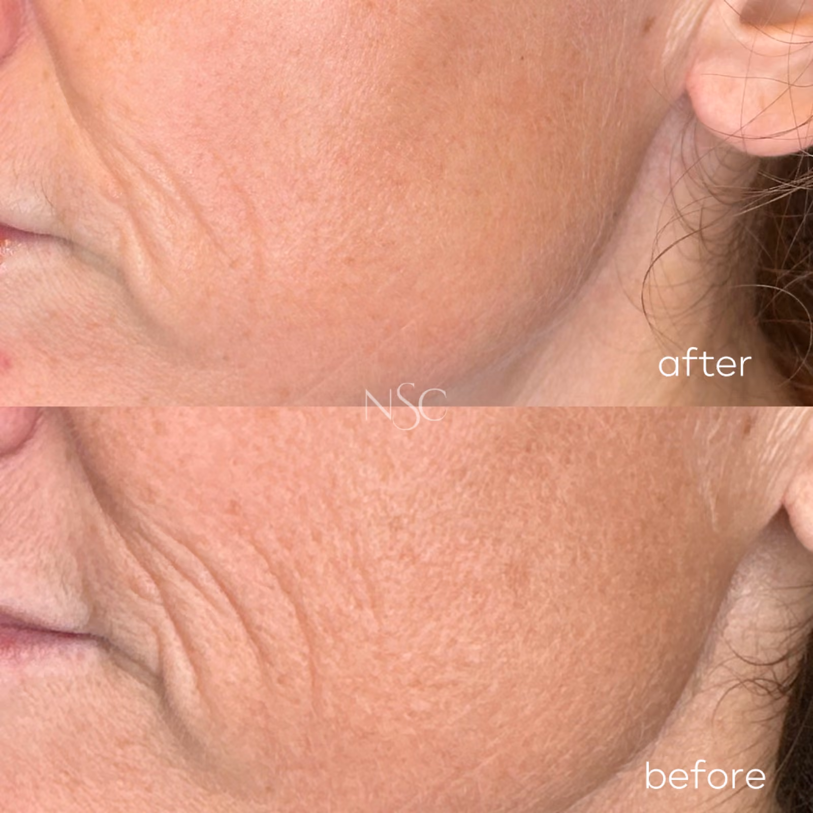 Ultherapy before and after results at Nashville Skin Company