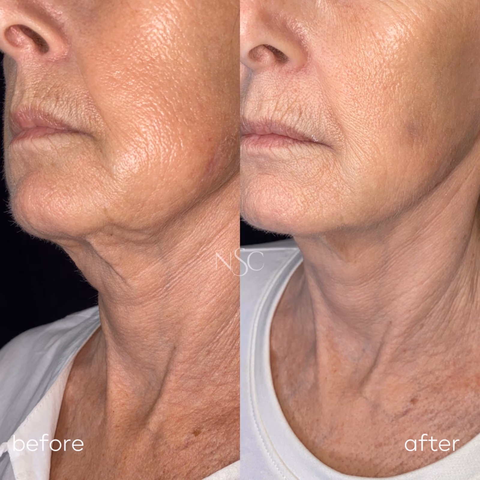 Ultherapy before and after results at Nashville Skin Company