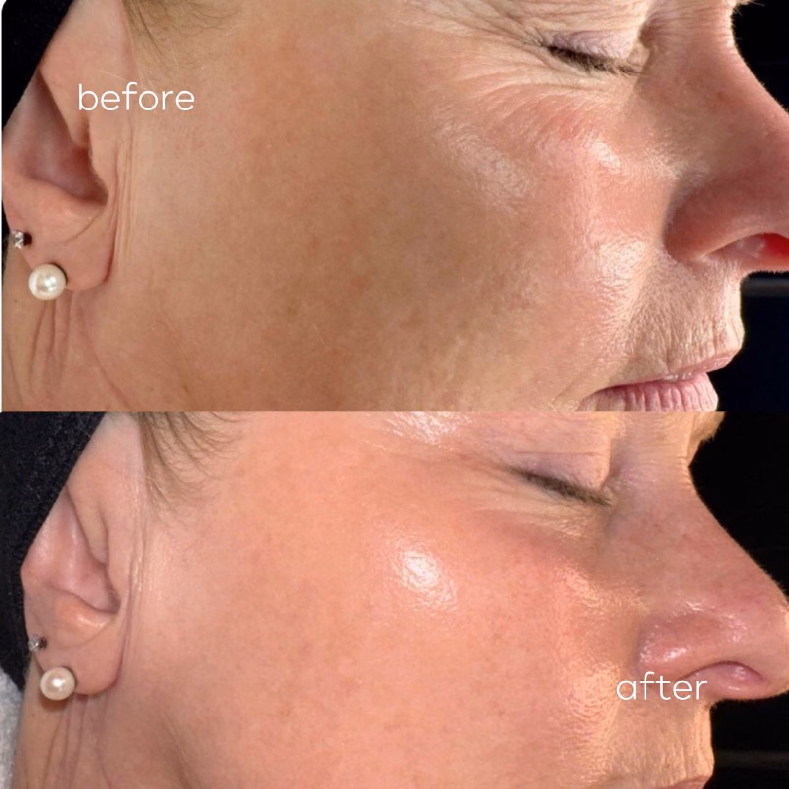 Treatment before and after results at Nashville Skin Company