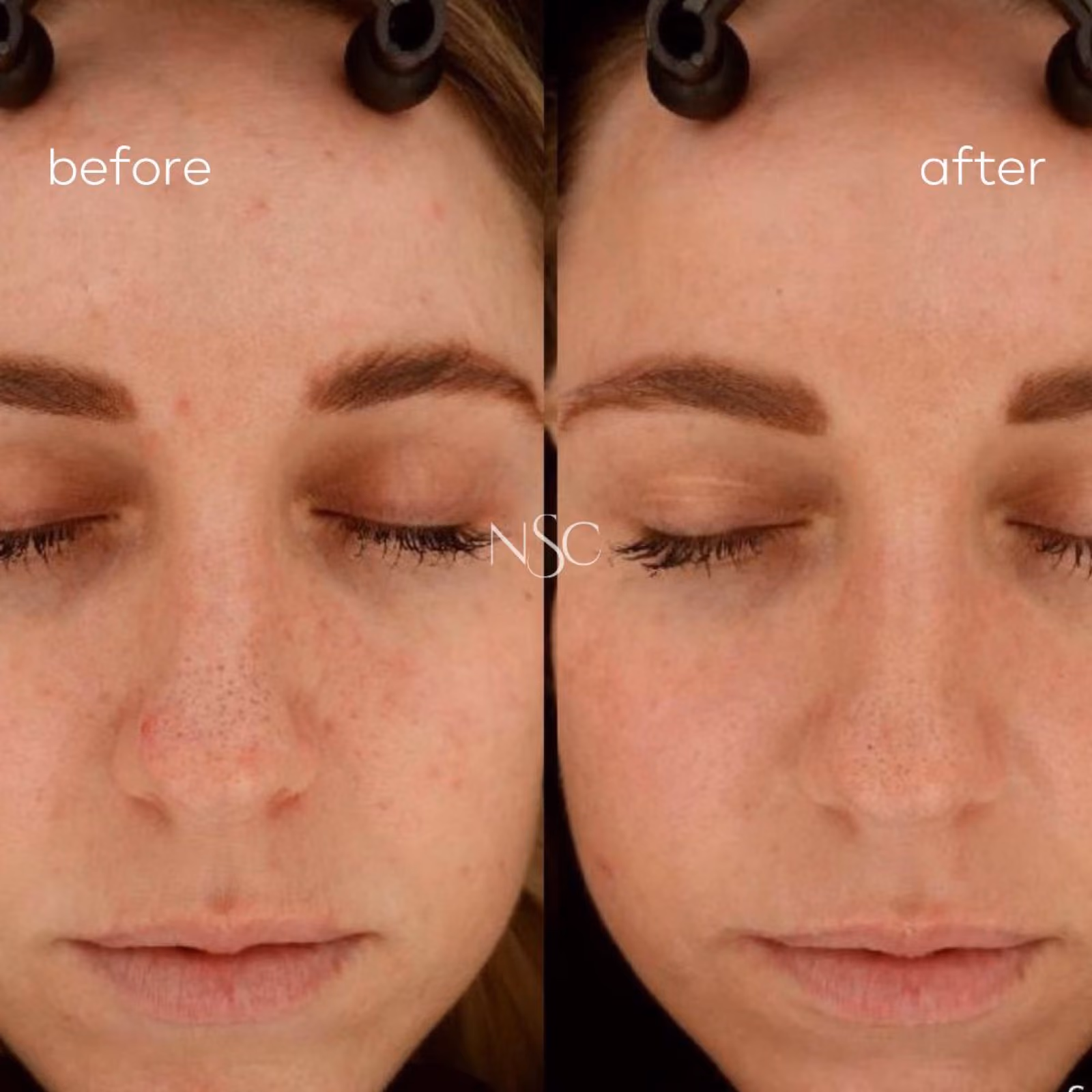Microneedling at Nashville Skin Company in Nashville, TN