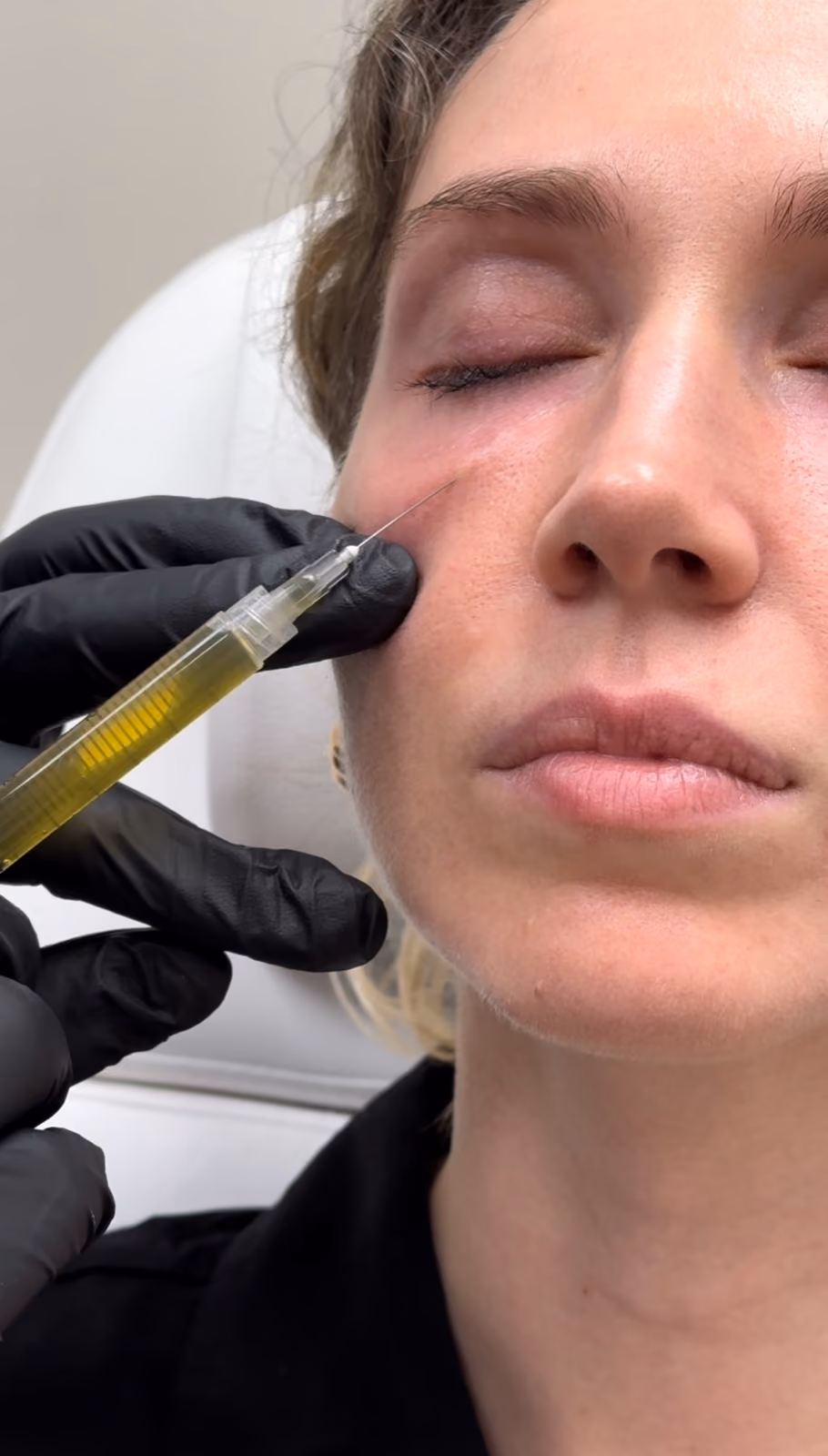 PRP platelet-rich plasma treatment at Nashville Skin Company in Nashville, TN