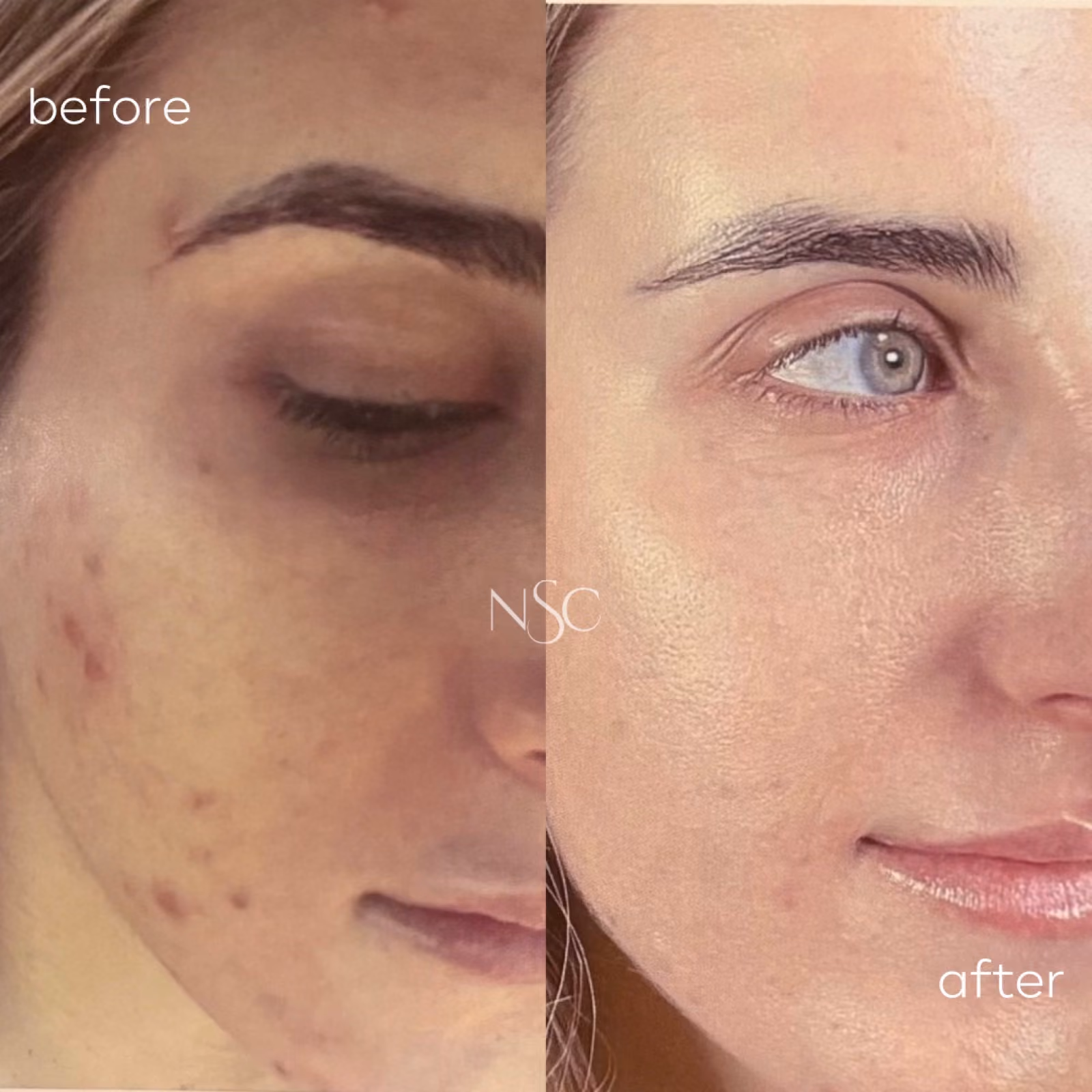 Chemical peel before and after results at Nashville Skin Company