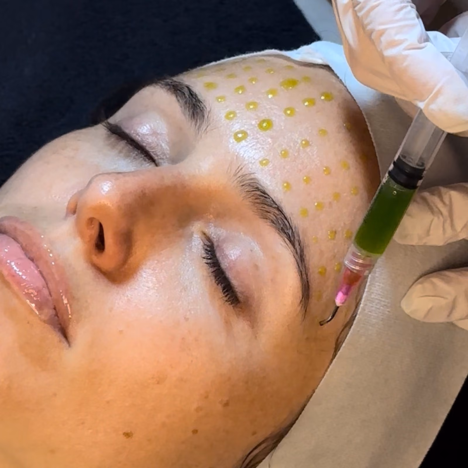 Chemical peel before and after results at Nashville Skin Company