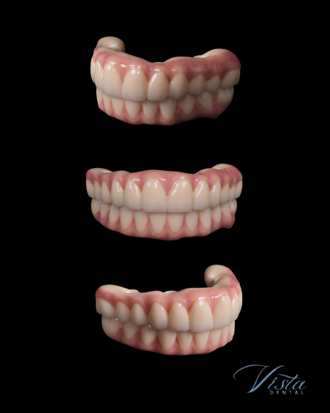 Full mouth All-on-4 Implants Final Set of Permanent Zirconia Teeth made by Vista Dental Implants in Vancouver, WA