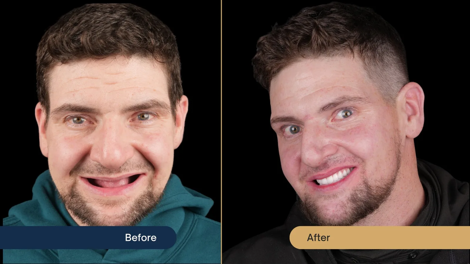 Before and after smile transformation — Vista Dental patient