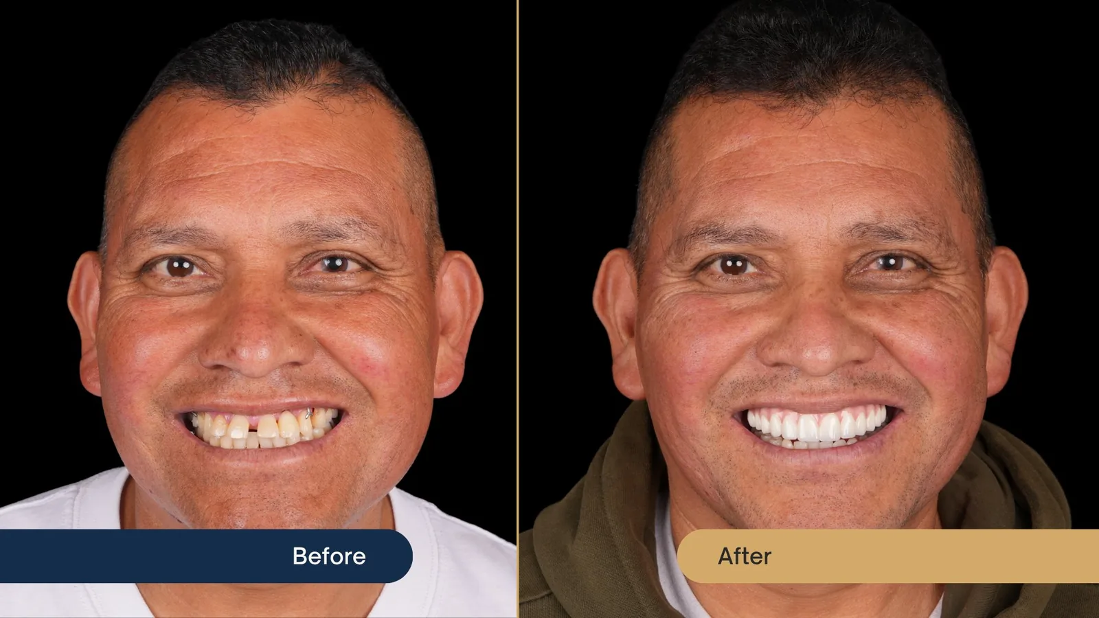Before and after full-arch dental implants — Vista Dental patient