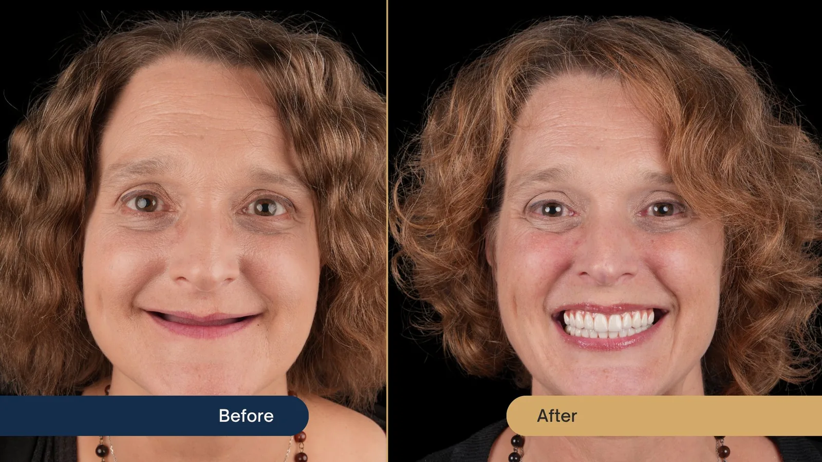 Before and after All-On-4 dental implants — Vista Dental patient