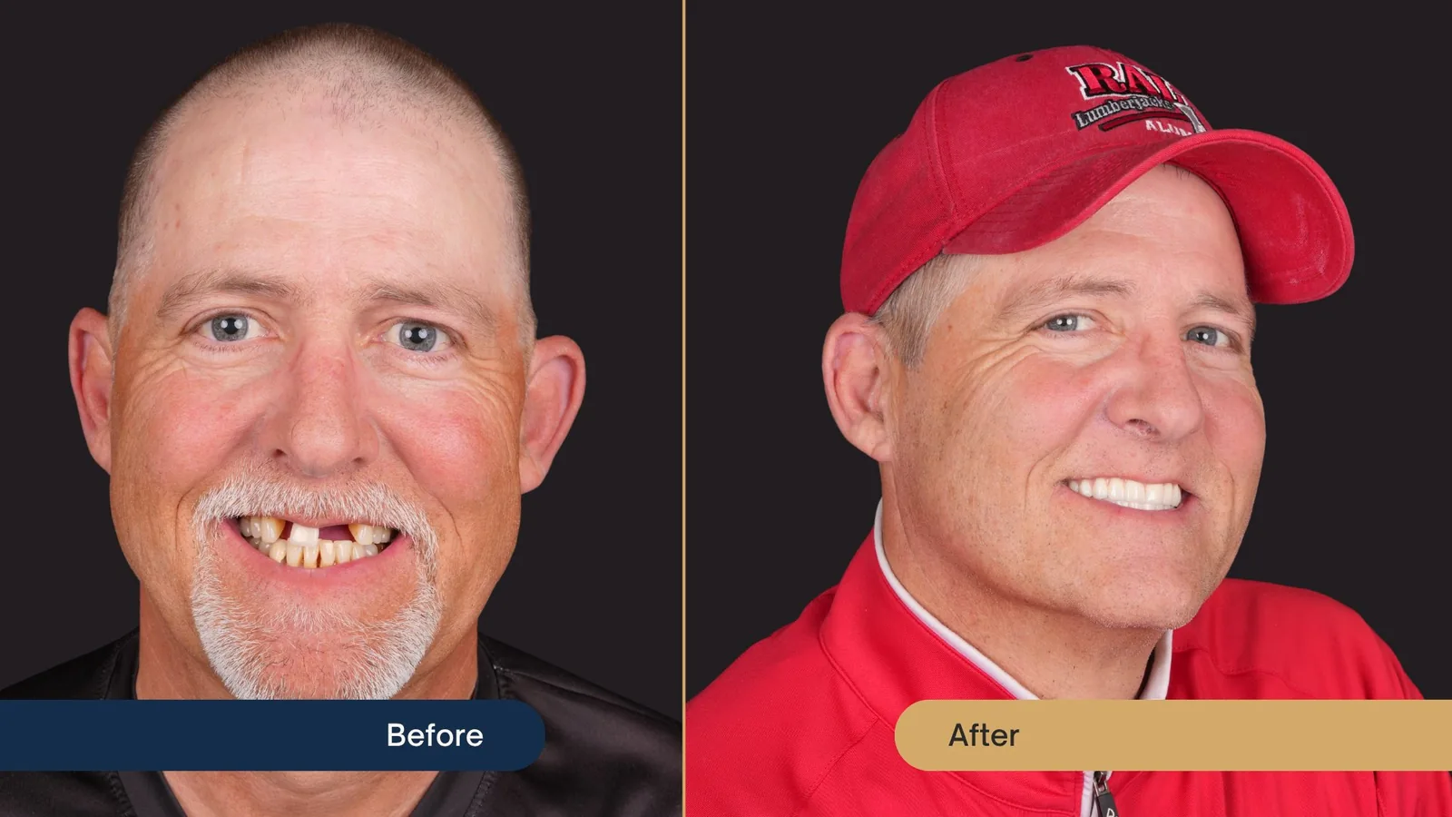 Before and after full-arch restoration — Vista Dental patient