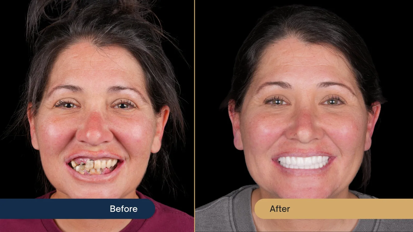 Before and after full-arch dental implants — Vista Dental patient