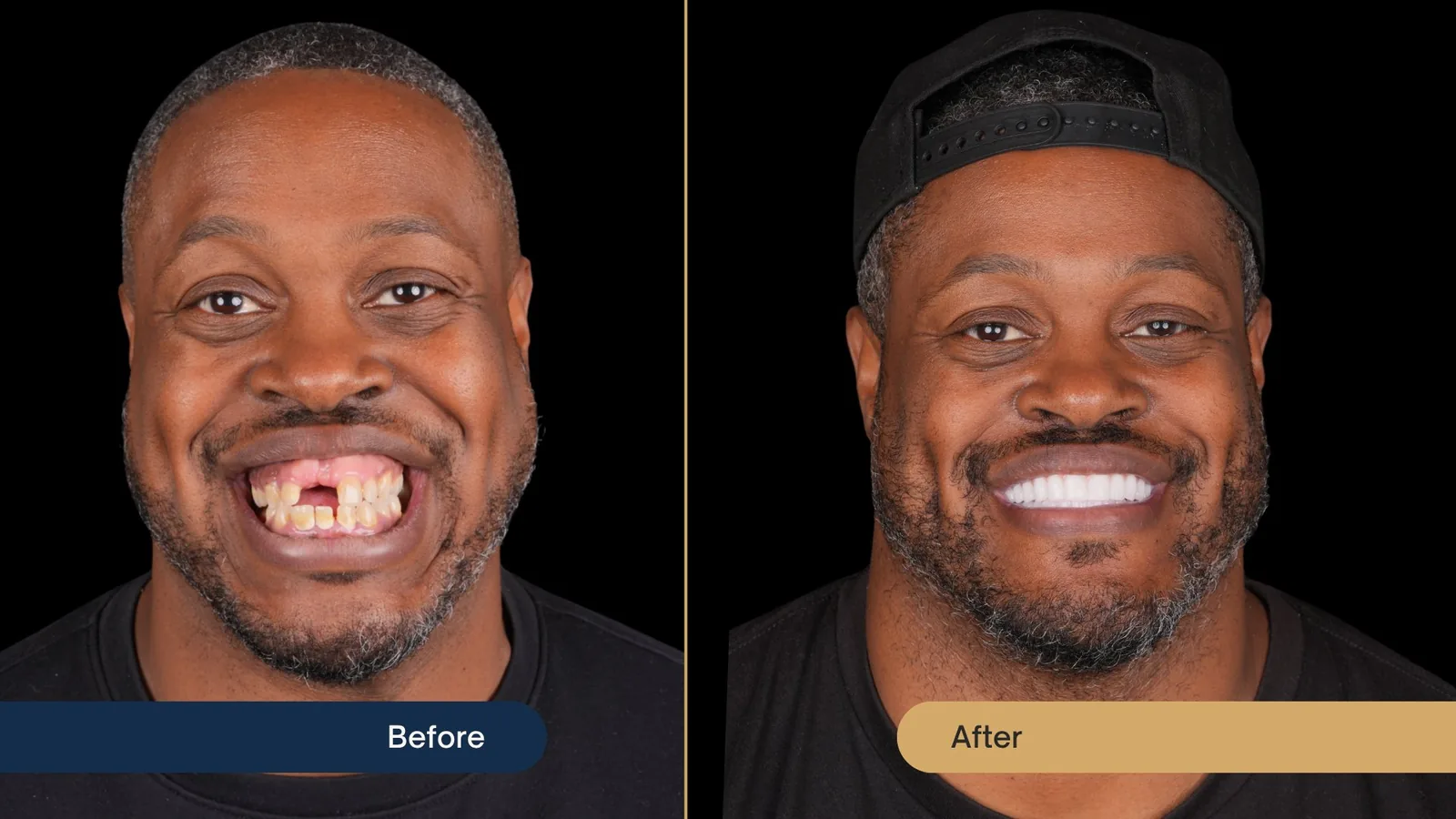 Before and after All-On-4 dental implants — Vista Dental patient