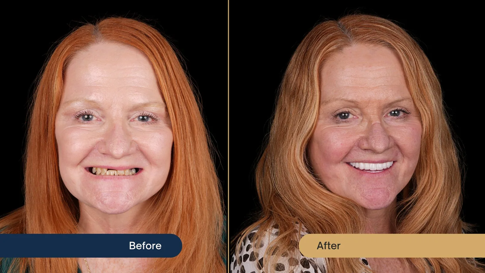 Before and after smile transformation — Vista Dental patient
