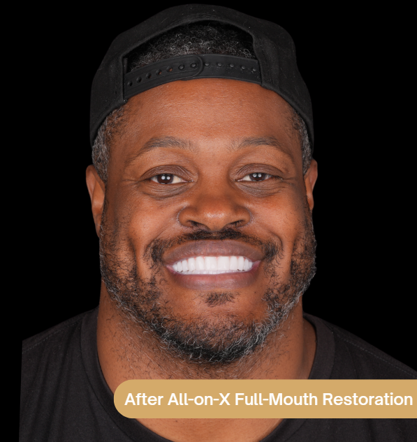 A patient who had al All-on-4 implant full-mouth restoration before and after