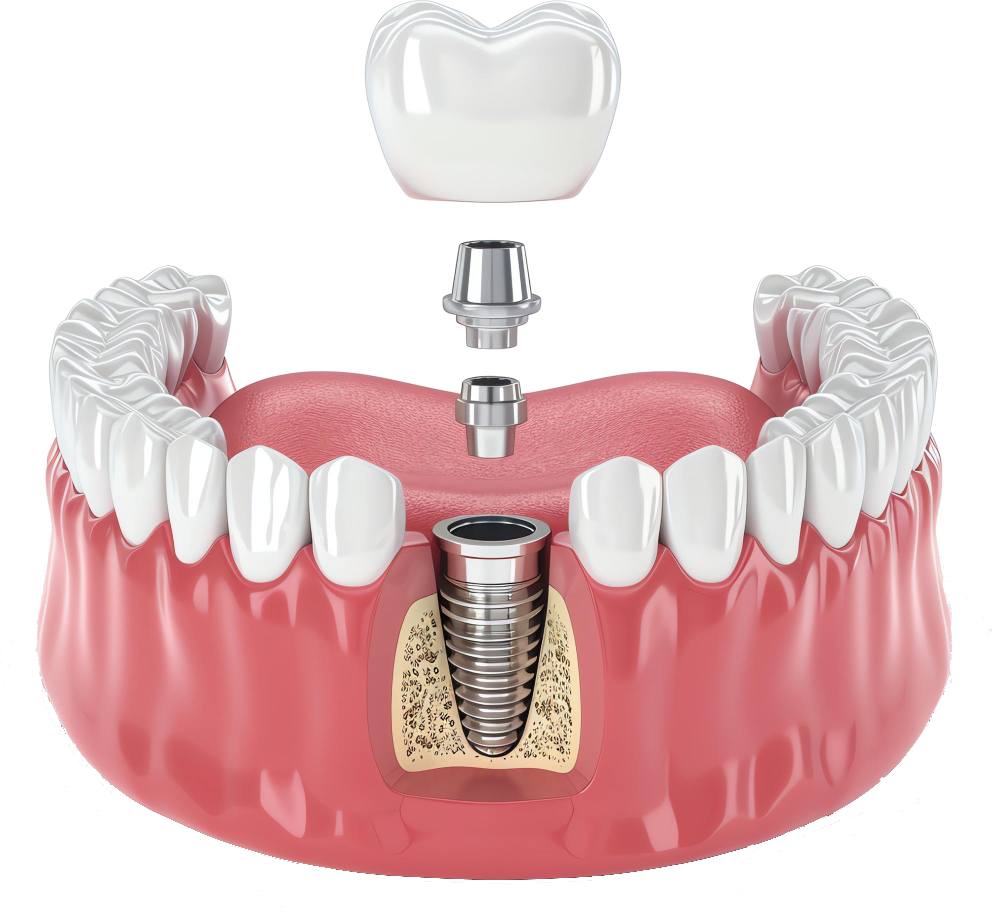 3D diagram showing a dental implant screw in the jawbone with abutment and crown above gum line.