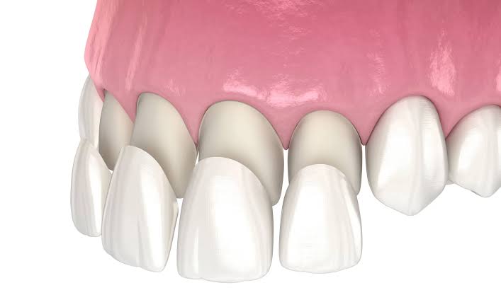 custom veneers by vista dental implants in vancouver, wa