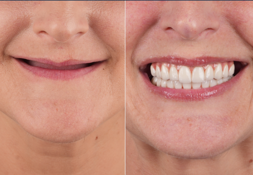 single arch all on 4 teeth