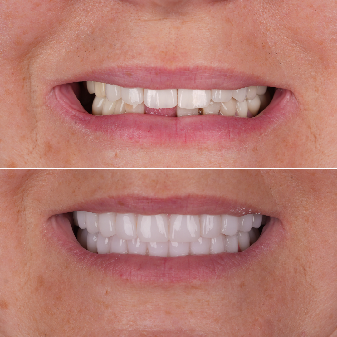 full mouth all on 4 set of teeth