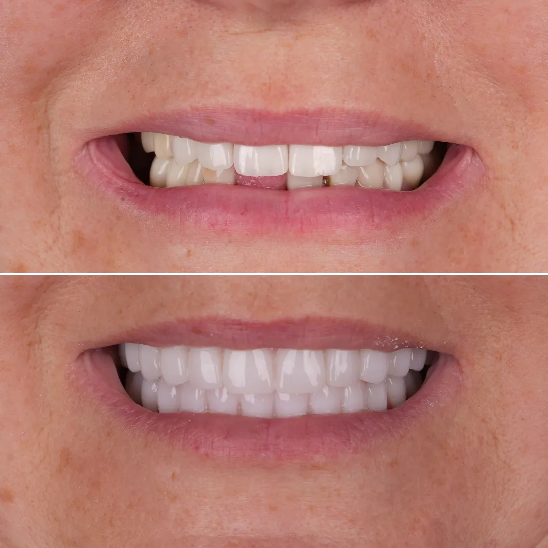 full mouth all on 4 set of teeth