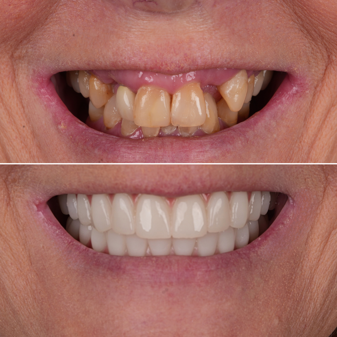 single arch all on 4 teeth