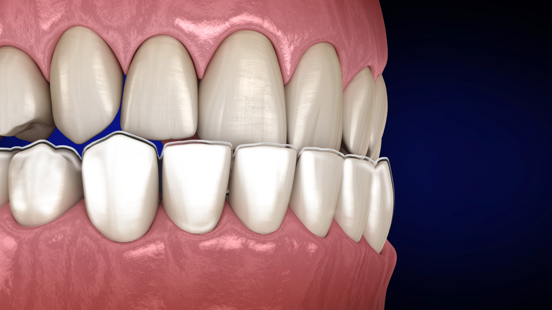 Underbite Explained: Causes, Classifications and Treatments Options