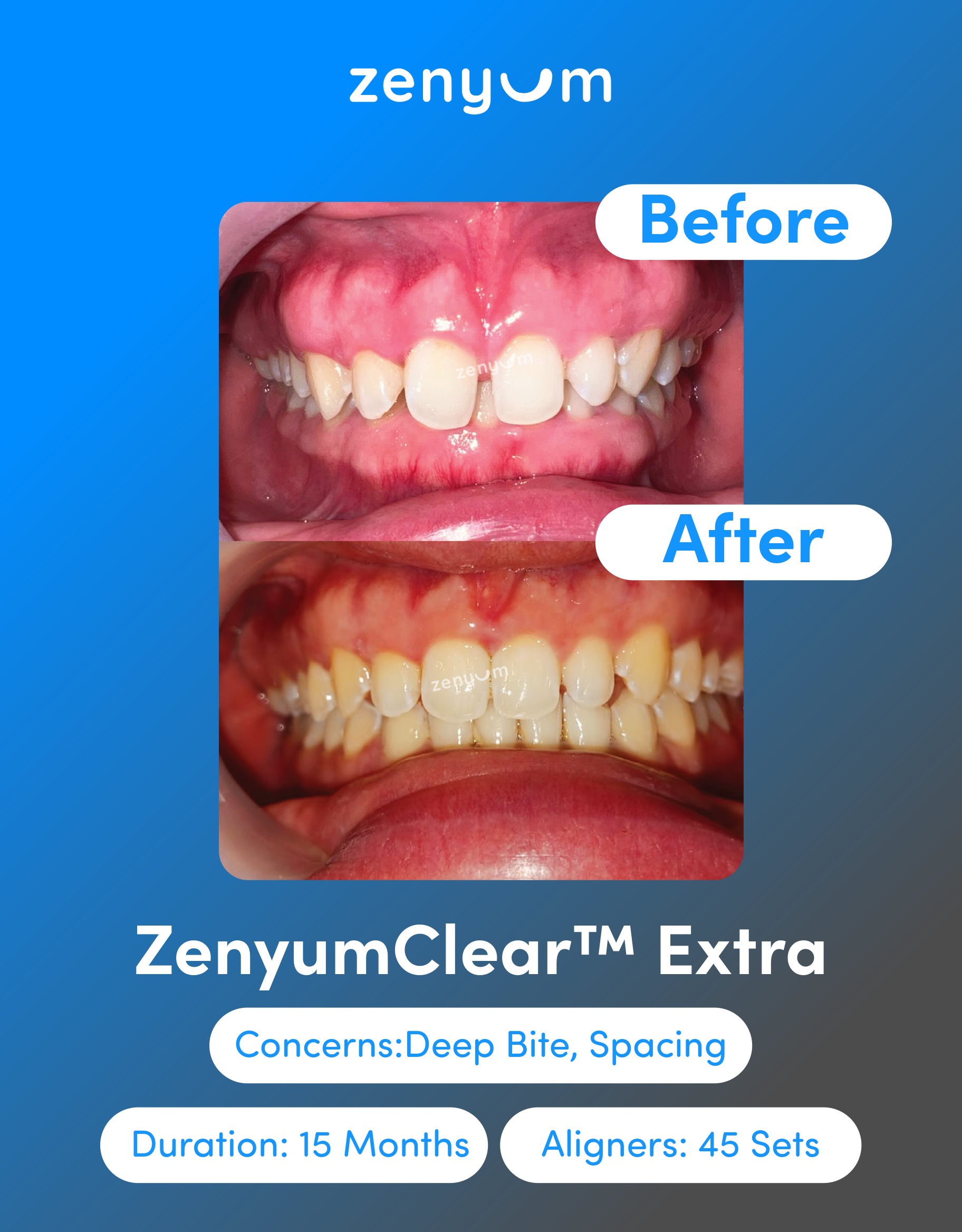 overbite before and after braces