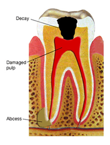 Root canal diagram