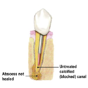 Endodontic retreatment