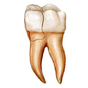 Cracked tooth with fractured cusp