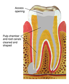 Root canal diagram