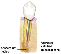 Root canal re-treatment diagram