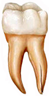 Vertical root fracture